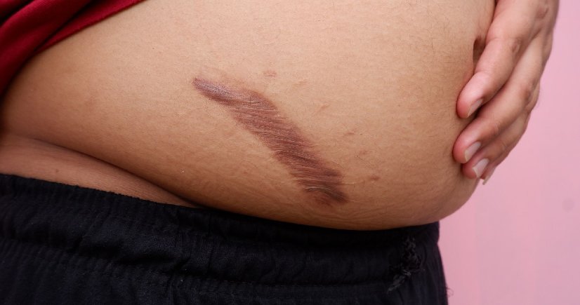 Keloid Treatment